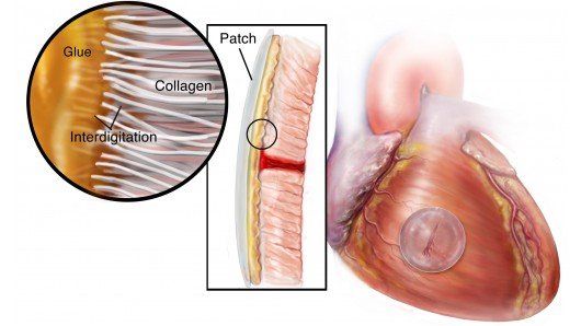 HLAA superglue fixes the hole in Heart
