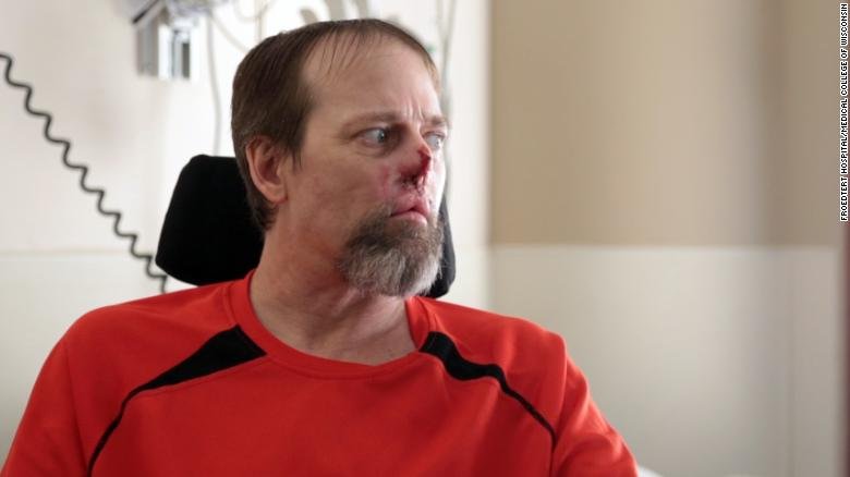 Man looses his Feet and Hands after dog related Infection